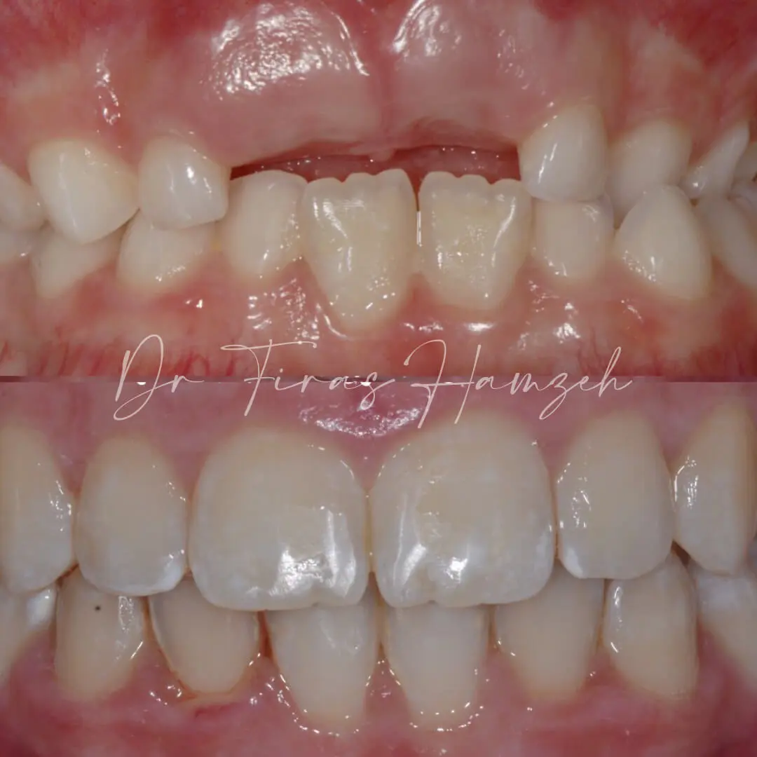 Before and after orthodontic case 1