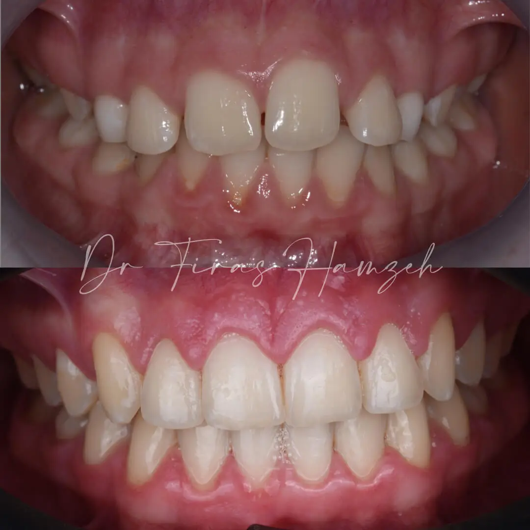 Before and after orthodontic case 5