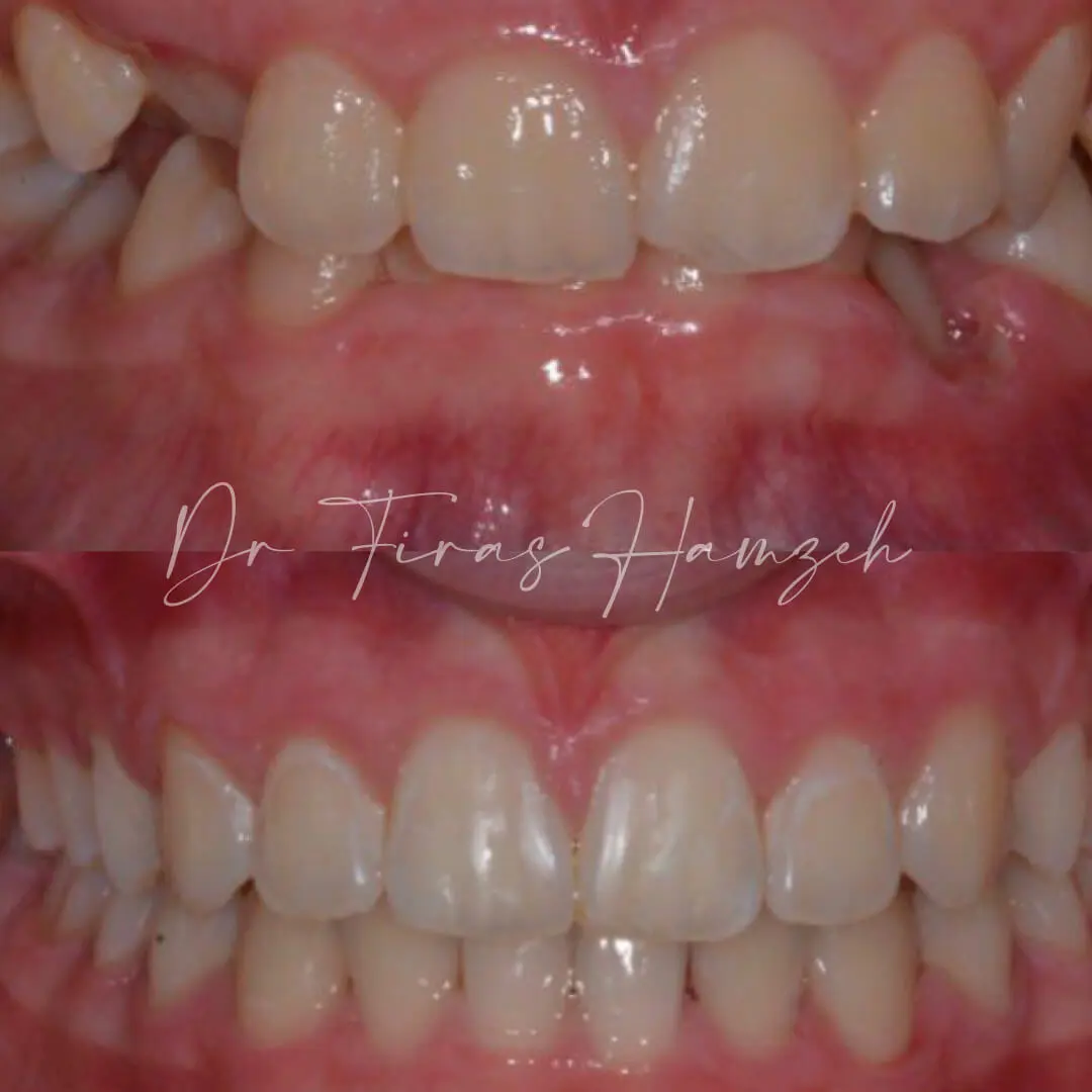 Before and after orthodontic case 6