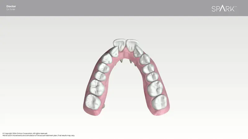 Spark Clear aligner-3D Digital Planning