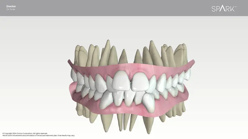 Invisibe aligners-3D Digital Planning